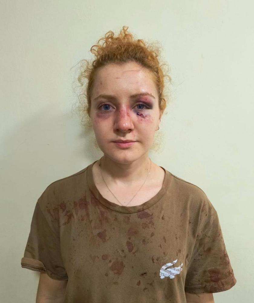 Achei que não sairia viva’: Jovem agredida em Ipaporã detalha ataque pelo amigo, sua namorada e a mãe da namorada